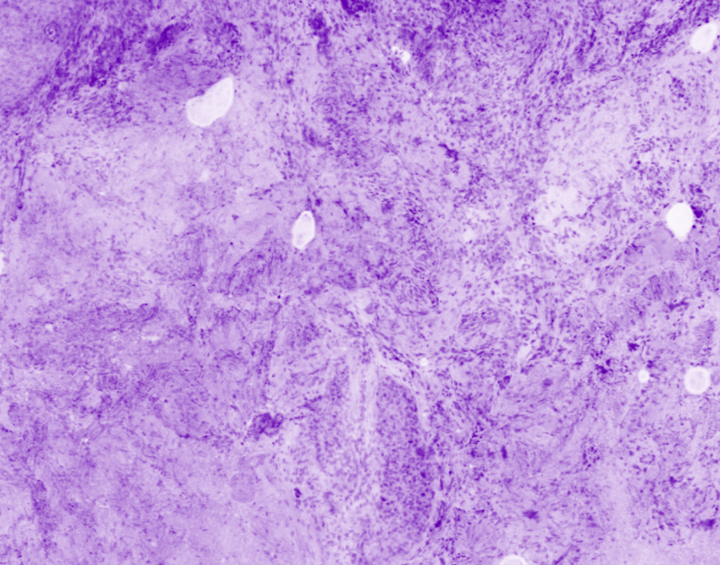 Skin specimen - Dermis