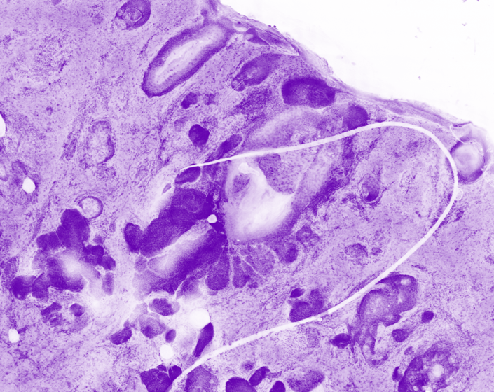Skin specimen - Neoplastic epithelium
