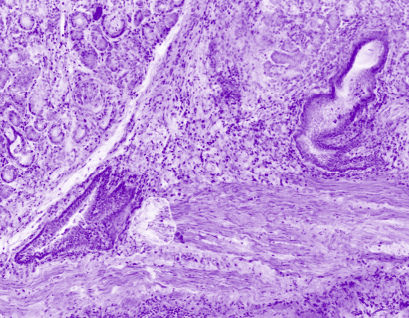 Broncus glandular ducts
