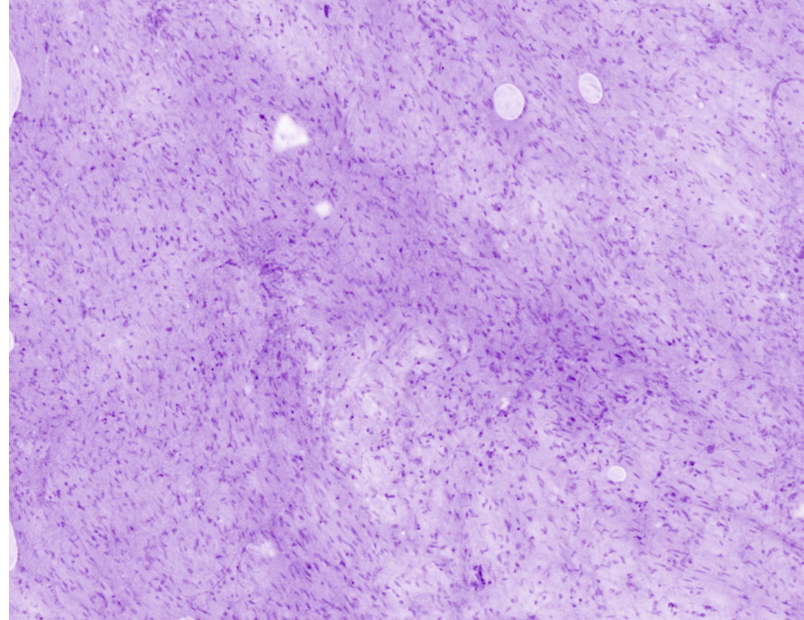 Prostatic capsula with fibroblasts
